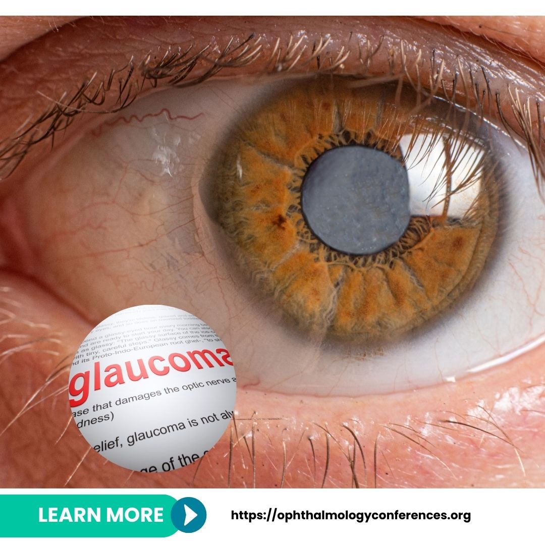 Glaucoma – The Silent Thief of Sight